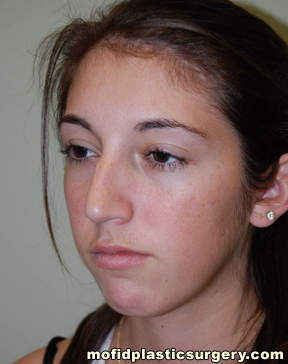 Nose Surgery Case 5828 Before Photo Nose Surgery