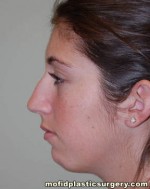 Nose Surgery