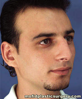 Nose Surgery Case 5836 Before Photo Nose Surgery