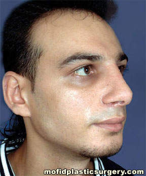 Nose Surgery Case 5836 After Photo Nose Surgery