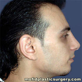 Nose Surgery Case 5836 After Photo Nose Surgery