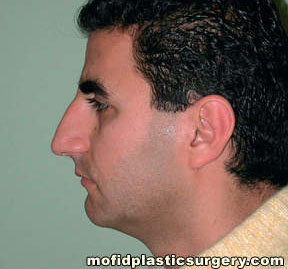 Nose Surgery Case 5842 Before Photo Nose Surgery