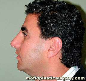 Nose Surgery Case 5842 After Photo Nose Surgery
