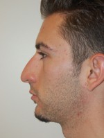 Nose Surgery