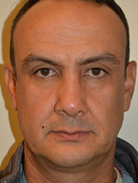 Nose Surgery Case 5852 After Photo Nose Surgery