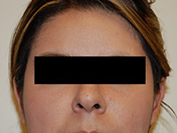 Otoplasty