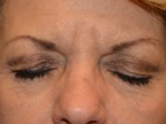 Eyelid Surgery