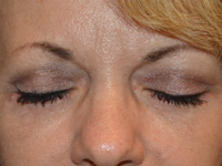 Eyelid Surgery Case 6321 After Photo Eyelid Surgery
