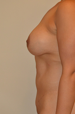 Breast Augmentation with Lift