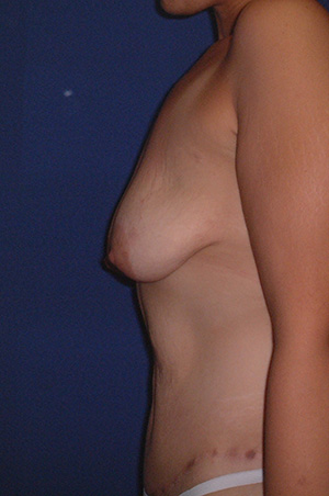 Breast Augmentation with Lift