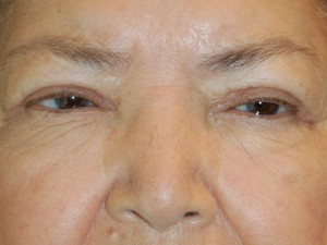Eyelid Surgery Case 5025 After Photo Eyelid Surgery