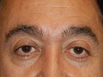 Eyelid Surgery