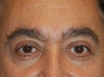 Eyelid Surgery
