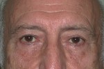 Eyelid Surgery