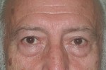 Eyelid Surgery