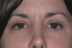 Eyelid Surgery