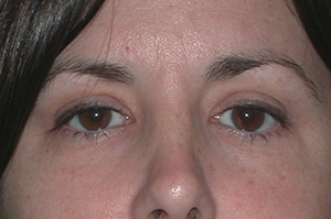 Eyelid Surgery Case 5100 After Photo Eyelid Surgery