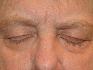 Eyelid Surgery Case 6454 Before Photo Eyelid Surgery