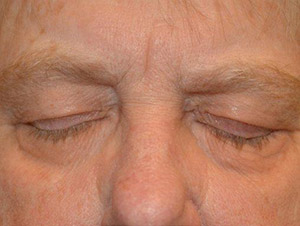 Eyelid Surgery