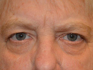 Eyelid Surgery Case 6454 Before Photo Eyelid Surgery