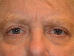 Eyelid Surgery
