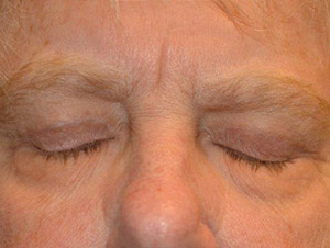Eyelid Surgery Case 6454 After Photo Eyelid Surgery