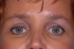 Brow Lift Case 6573 After Photo Brow Lift