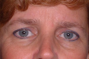 Brow Lift Case 6573 Before Photo Brow Lift
