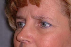 Brow Lift Case 6573 Before Photo Brow Lift