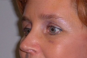 Brow Lift Case 6573 After Photo Brow Lift