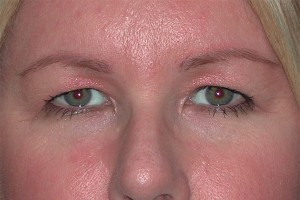 Brow Lift Case 4914 Before Photo Brow Lift