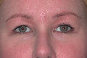 Brow Lift Case 4914 After Photo Brow Lift
