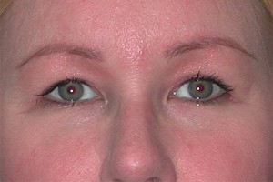 Brow Lift