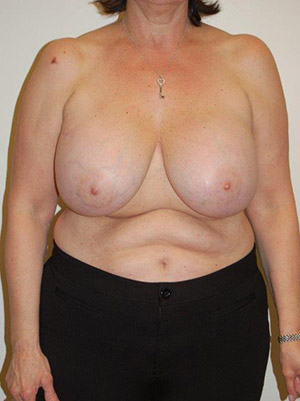 Breast Lift Case 6531 Before Photo Breast Lift