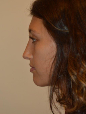 Nose Surgery Case 6856 After Photo Nose Surgery
