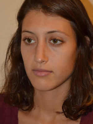 Nose Surgery Case 6856 After Photo Nose Surgery