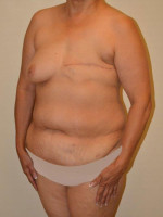 Breast Reconstruction