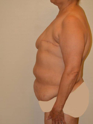 Breast Reconstruction Case 6539 Before Photo Breast Reconstruction