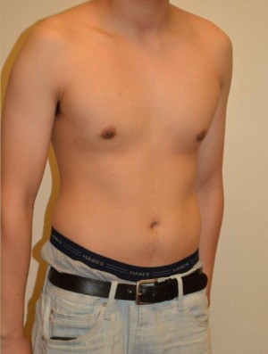 Gynecomastia