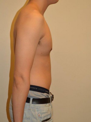 Gynecomastia Case 12789 After Photo Gynecomastia