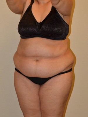 Tummy Tuck Case 12795 Before Photo Tummy Tuck