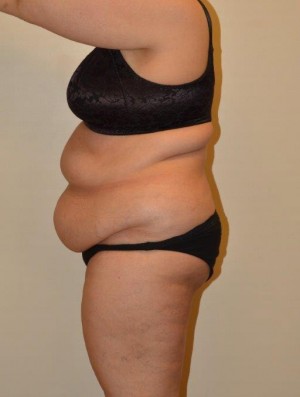 Tummy Tuck Case 12795 Before Photo Tummy Tuck