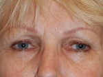Eyelid Surgery