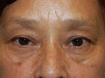Eyelid Surgery