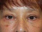 Eyelid Surgery