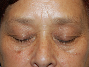 Eyelid Surgery Case 6602 Before Photo Eyelid Surgery