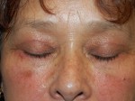 Eyelid Surgery
