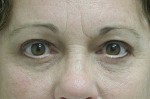 Eyelid Surgery