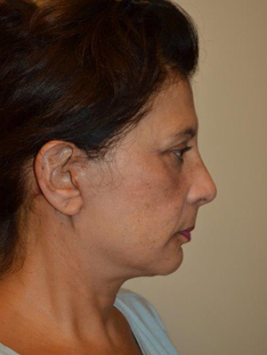 Facelift and Necklift Case 6561 After Photo Facelift and Necklift