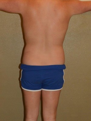 Liposuction Case 6820 Before Photo Liposuction